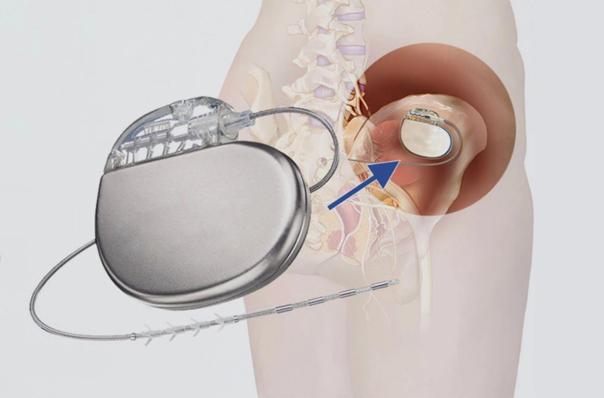 Advanced Bladder Treatment with Expert Urologists